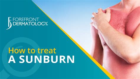 How To Treat Sunburn How To Treat Sunburn