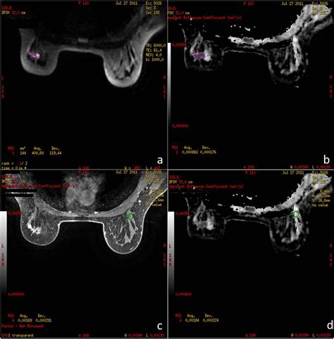 Impact Of Fibroglandular Tissue And Background Parenchymal Enhancement