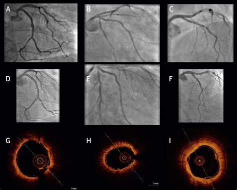 Current Status Of Bioresorbable Scaffolds In The Treatment Of Coronary