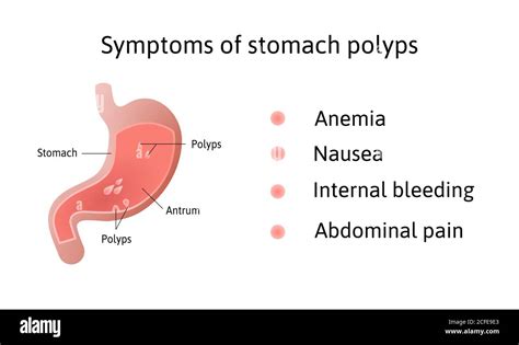 Gastric Polyp Stock Vector Images Alamy