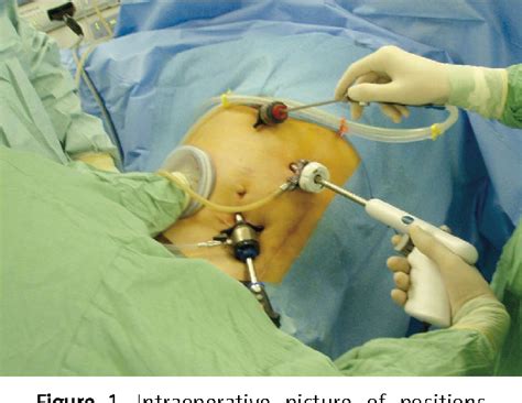 Figure 1 From Hand Assisted Laparoscopic Liver Resection Using Habibs Technique Early