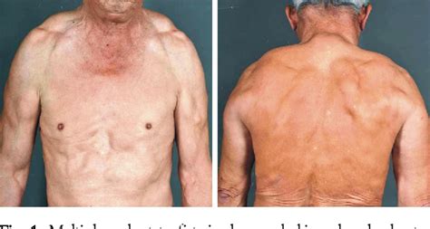 Figure 1 From Fast Growing Multiple Symmetric Lipomatosis Semantic