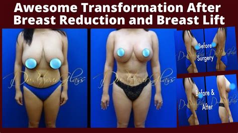 Awesome Breast Transformation After Her Breast Reduction And Breast