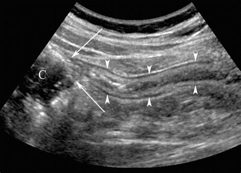 Terminal Ileum Ultrasound