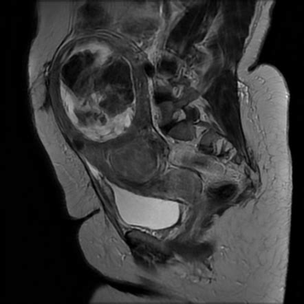 Uterine fibroid with cystic degenration | Radiology Case | Radiopaedia.org