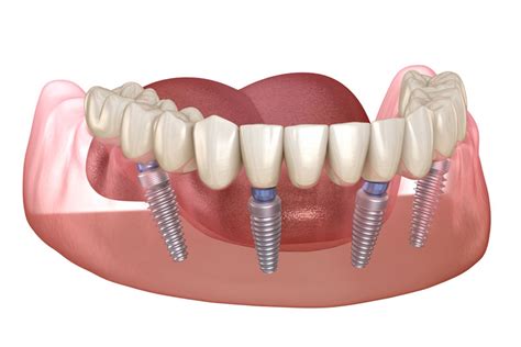 Are You A Candidate For All On 4® Dental Implants In Leesburg Va