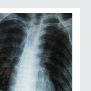 Bilateral infiltrates of the lower lung fields, compatible with... | Download Scientific Diagram