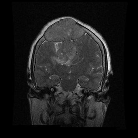 Solitary Fibrous Tumor Hemangiopericytoma Image Radiopaedia Org