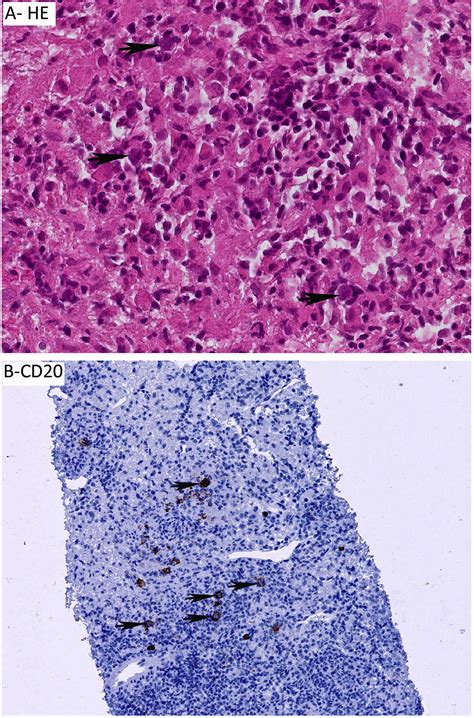 Nodular Lymphocyte Predominant Hodgkin Lymphoma Pathology Clinical Course And Relation To T