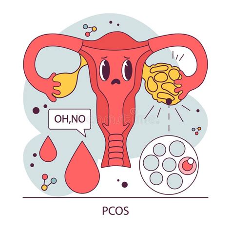 Polycystic Ovary Syndrome Pcos Hormonal Disease Stock Vector