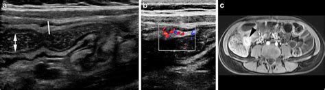 A Diagnosis Of Terminal Ileitis By Ultrasound In A 16 Year Old Girl Download Scientific Diagram