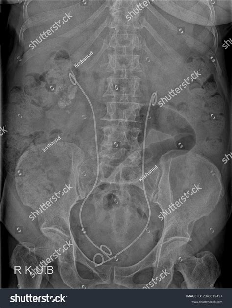 Displaying Stent Both Uretere Royalty-Free Images, Stock Photos ...