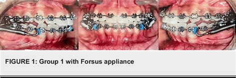 Figure 1 From Evaluation Of Clinical Efficacy Between Forsus And Advansync Fixed Functional