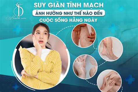 SUY GIÃN TĨNH MẠCH ẢNH HƯỞNG NHƯ THẾ NÀO ĐẾN CUỘC SỐNG HẰNG NGÀY