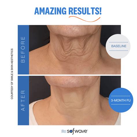 SofWave Skin Tightening Treatment U S Dermatology Partners