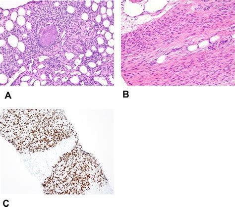 Phosphaturic Mesenchymal Tumors What An Endocrinologist Should Know