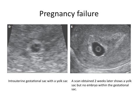 Abnormal Ultrasound in Early Pregnancy