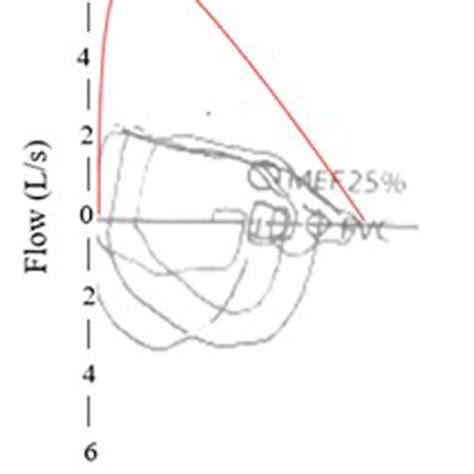 Maximal Expiratory Flow Volume Curve In A Patient With Complete Download Scientific Diagram