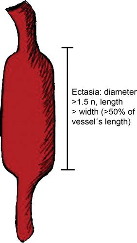 Coronary Artery Aneurysms And Ectasia Role Of Coronary Ct Angiography