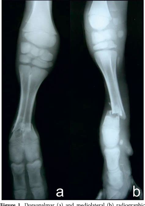 Figure 1 from The treatment of distal metacarpus fracture with locking compression plate in ...