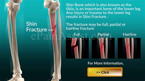 Tibia Bone Fracture