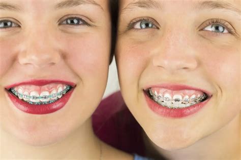 Braces Colors How To Pick The Best Colors For Your Braces