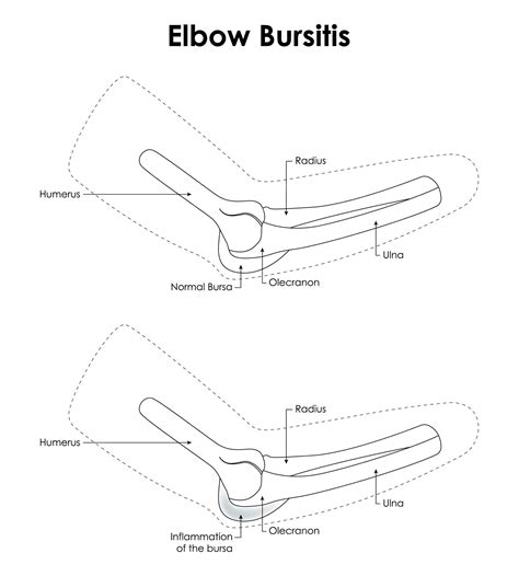 Premium Vector | Elbow Bursitis Radius Humerus Normal Bursa Olecranon