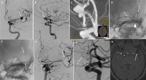 A And B Complex Wide Necked Left Middle Cerebral Artery Mca