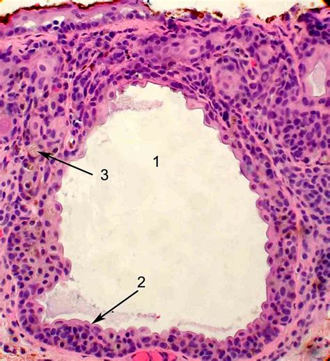 Ocular Pathology: Conjunctiva-Compound Nevus