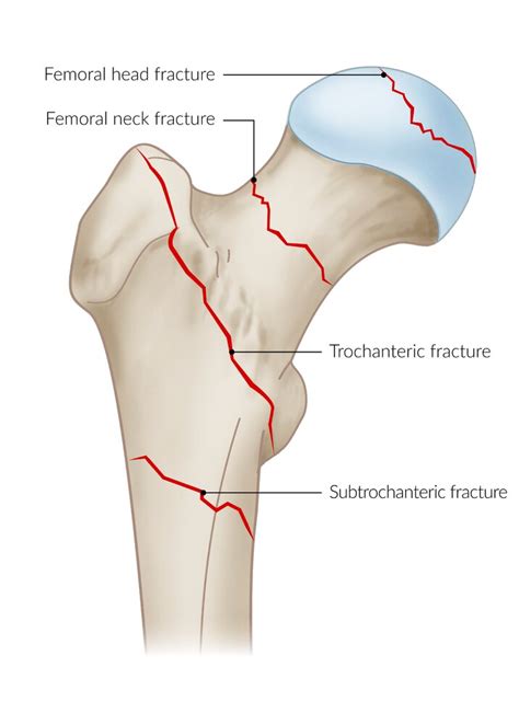 Intertrochanteric Fracture