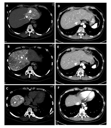 The Representative Dynamic Contrast Enhanced Computed Tomography Images