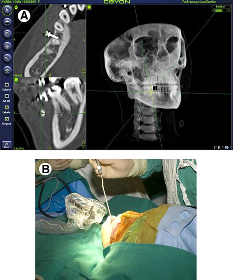 Navigation Assisted Intraoral Vertical Ramus Osteotomy Journal Of Oral And Maxillofacial Surgery