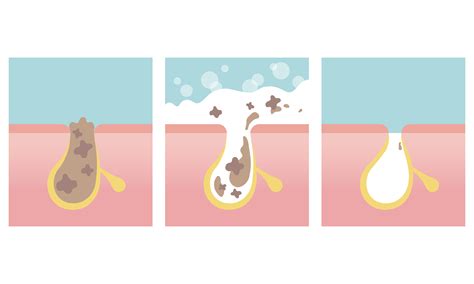 Große Poren verkleinern mit Tipps, Hausmitteln und Peelings