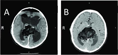 A B Ct Images A Post Operative And B 18 Months Post Operative