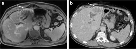 A B Axial Delayed Contrast Enhanced T1 Weighted Vibe Mr A And Mdct