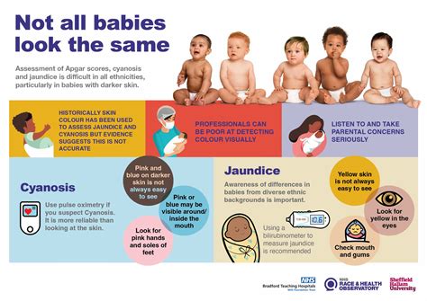 My baby is yellow / jaundice :: Hertfordshire and West Essex Healthier