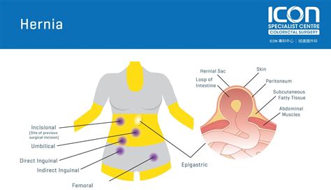 Hernia Icon Specialist Centre