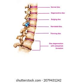 Anatomy Human Spine Disease Stock Illustration 2079431242 | Shutterstock