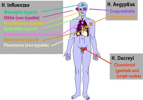 Doctors Gates: Clinical symptoms of Haemophilus influenzae Vs ...