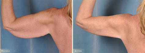 Arm Lift Before And After Colorado Plastic Surgery Center