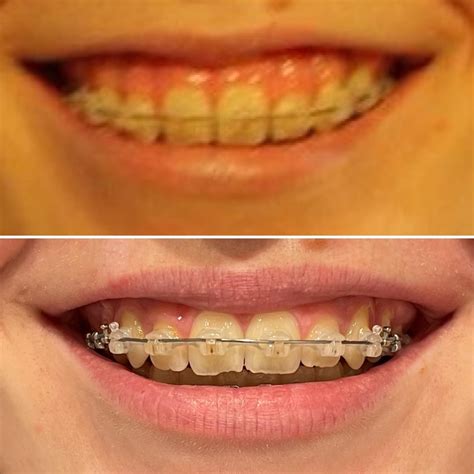 The Tads Are Out After 15 Months Here Are The Results On My Gummy Smile Braces