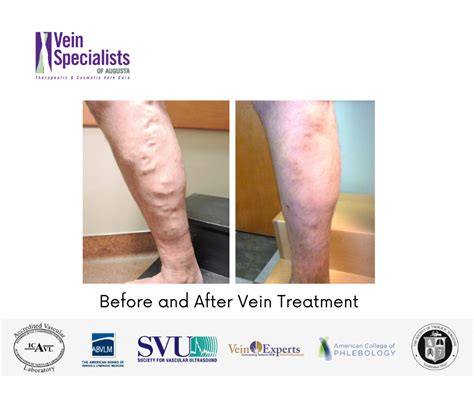 Closurefast For Saphenous Vein Reflux Vein Specialists Of Augusta