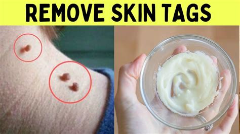 How To Remove Skin Tags Painlessly From Eyelids In One Night At Home