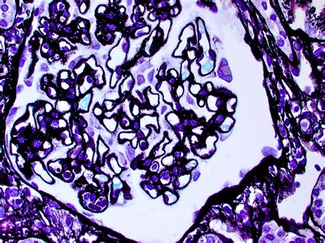 Liver and Kidney Transplant Pathology: Membranous Nephropathy