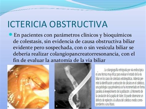 Ictericia obstructiva