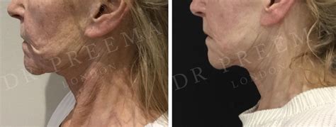 Skin Resurfacing Dr Preema London Clinic