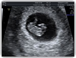 WHAT IS A FIRST TRIMESTER ULTRASOUND?