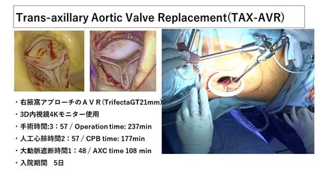 MICS AVR Trans Axillary Aortic Valve Replacement TAX AVR YouTube