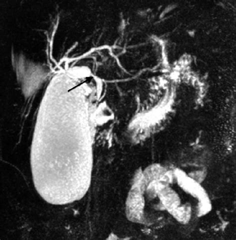 Biliary Tree Bile Duct Anatomy