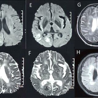 Brain Mri Of The Patient In August Dwi Showed The High Signal In